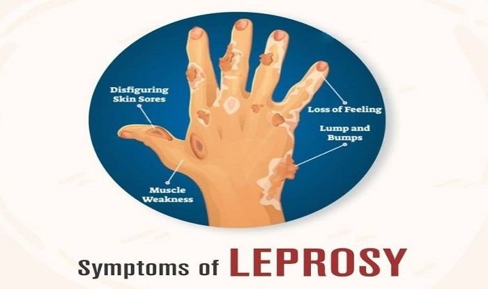 Leprosy Cases Surge in Central Florida, CDC Issues Alert