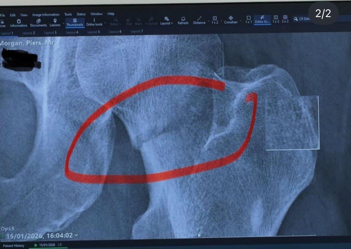X-ray image showing highlighted area of a knee joint, used for diagnostic purposes in orthopedics.